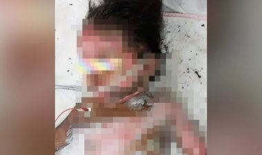 Kanak-kanak melecur 46 peratus bahagian tubuh akibat disambar api ketika main bunga api