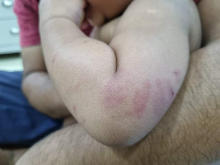 Taska kanak-kanak perempuan 'digigit' diarah tutup sementara